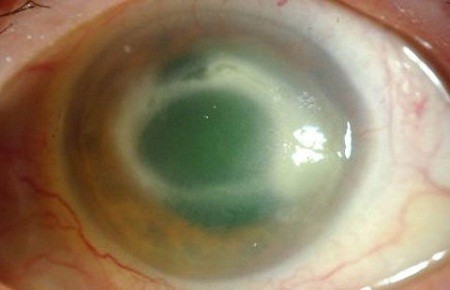 Mắt này hỏng vì kí sinh trùng Acanthamoeba sống bám vào những vi khuẩn được tìm thấy ở những kính áp tròng bẩn. Khi những kính áp tròng nhiễm khuẩn được đeo vào mắt, ký sinh trùng bắt đầu ăn mòn giác mạc, màng mắt và tiếp tục sinh sôi.